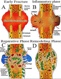 Knogle bruds healing